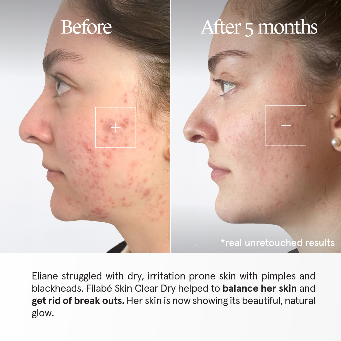 Filabé of Switzerland | SKIN CLEAR DRY | Skincare for Dry Skin with Redness, Irritations | All Ages